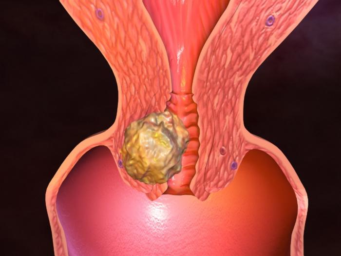 Рак матки симптомы