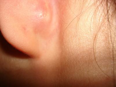 воспаление лимфоузлов за ухом
