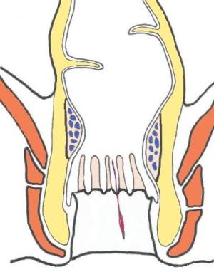 лечение хронической анальной трещины