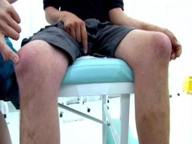 бурсит коленного сустава симптомы 