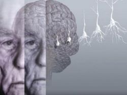 Сосудистая деменция: причины возникновения