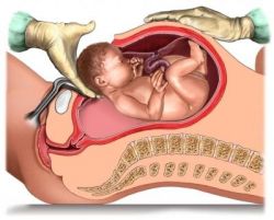 купить Пессарии Dr.Arabin