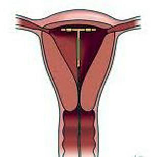 спираль внутриматочная мультилоад