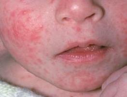 себорейный дерматит на лице лечение