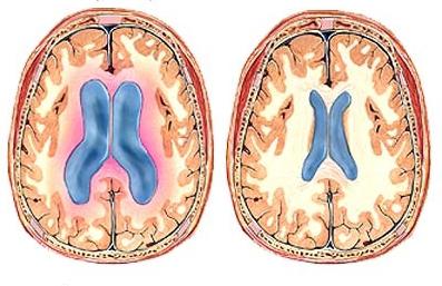гидроцефалия у детей фото