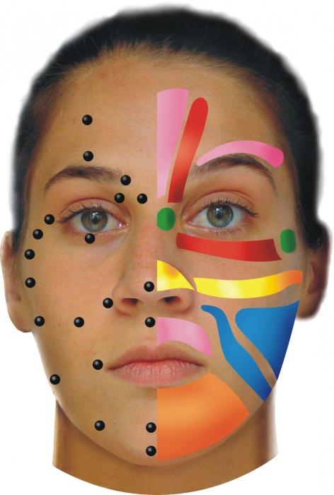 парез лицевого нерва лечение