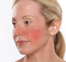 лечение купероза на лице