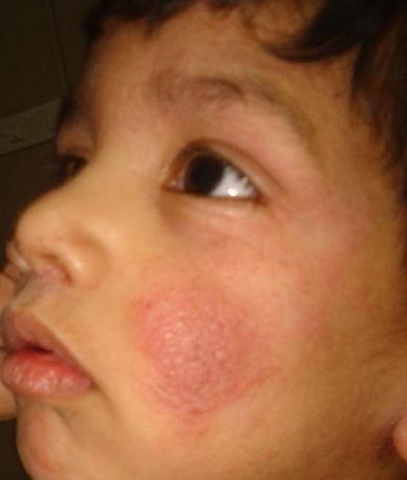 аллергический дерматит у детей лечение