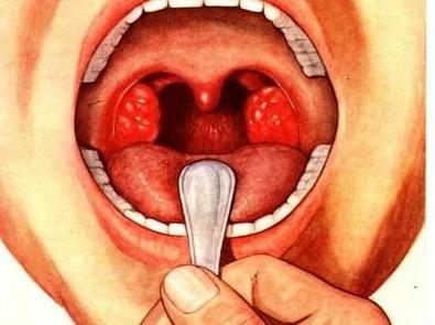 полоскание горла при ангине