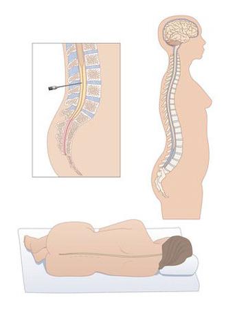 пункция спинного мозга последствия
