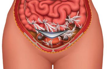 признаки спаечного процесса в малом тазу