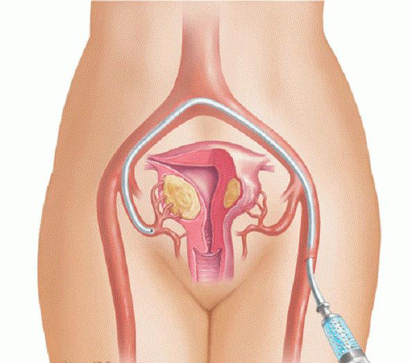 10 женских органов. Эмболизация миомы матки. Женская анатомия. Женский половой орган.