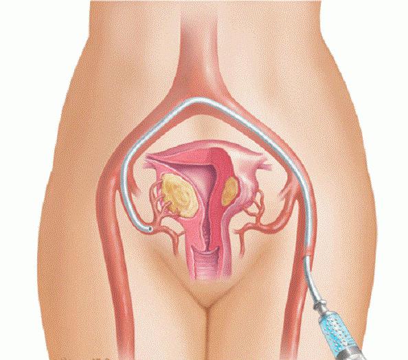 лечение миомы без операции 