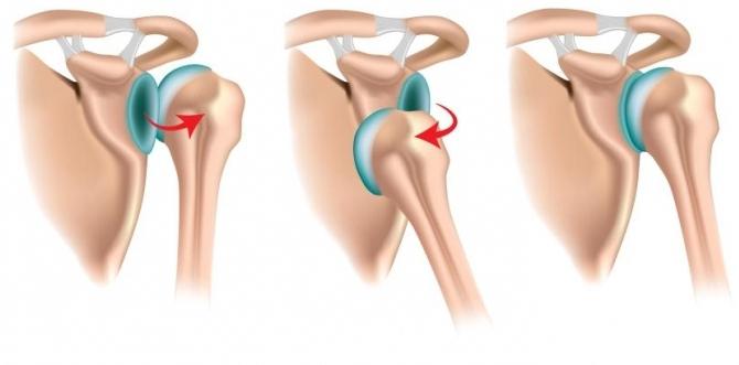 вывих плеча