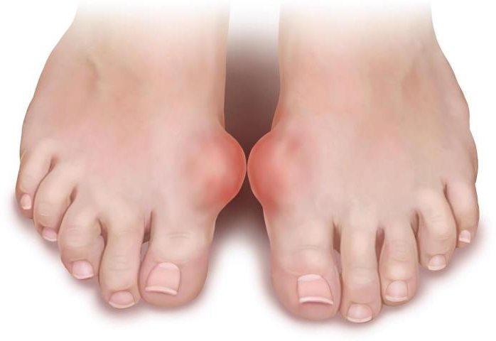артрит пальца ноги