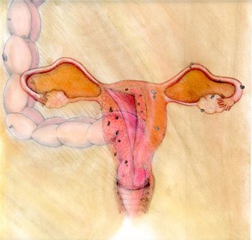 эндометриоз и зачатие
