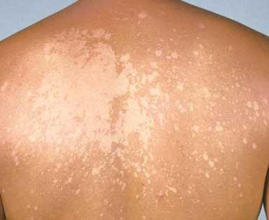 грибковые заболевания кожи