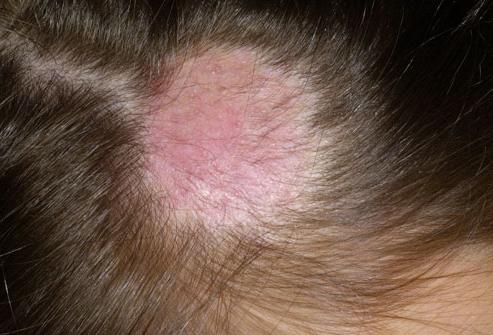 грибковое заболевание кожи головы