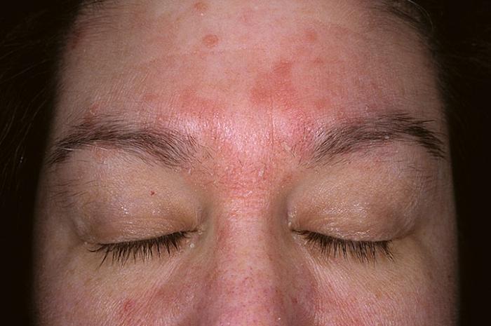лечение себорейного дерматита на лице