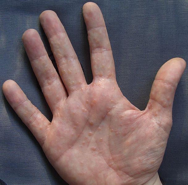 мазь от дерматита на руках
