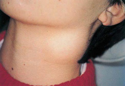 увеличение лимфатических узлов на шее