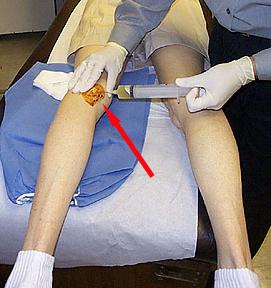 киста бейкера коленного сустава лечение