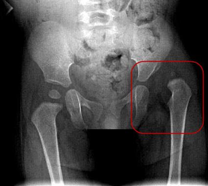 дисплазия тазобедренных суставов у детей диагностика 