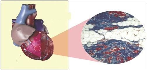 дисплазия соединительной ткани сердца