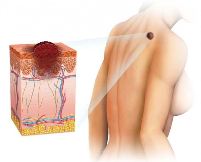 меланома симптомы