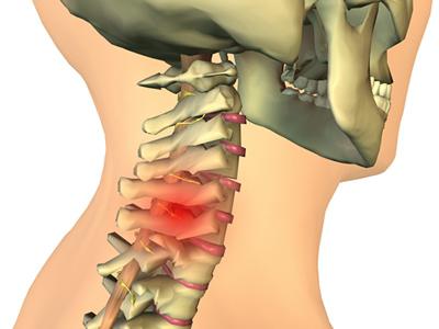 грыжи шейного отдела позвоночника лечение 