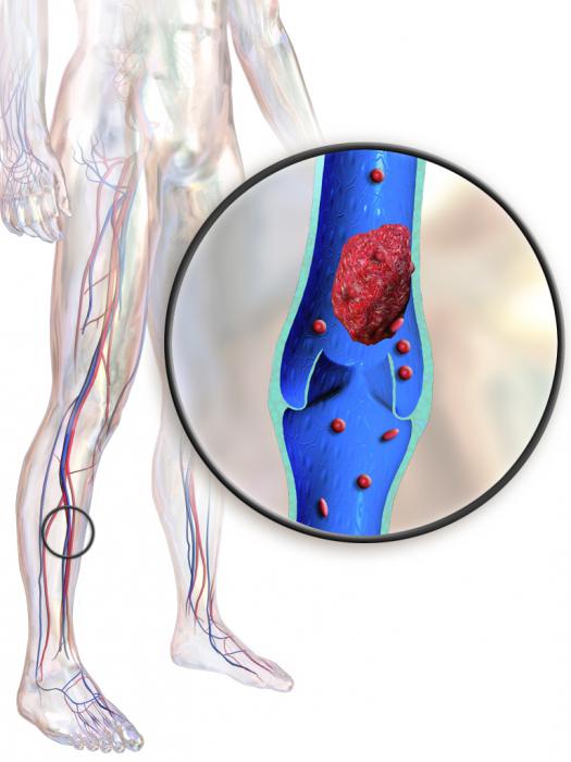 тромбофлебит глубоких вен нижних конечностей 