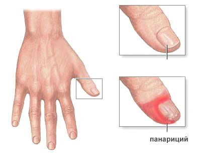 панариций пальца лечение 