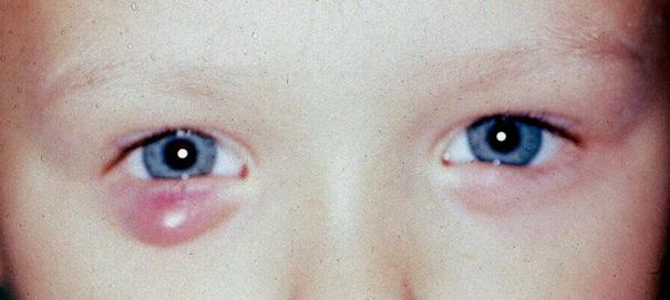 тетрациклиновая глазная мазь для детей
