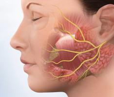 лечение неврита лицевого нерва