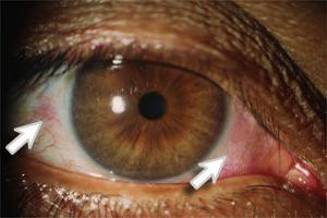 Синдром сухого глаза Систейн ультра