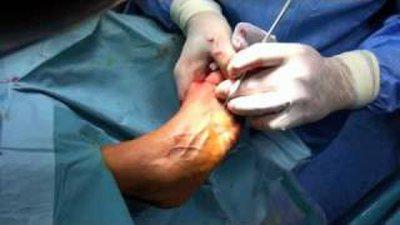 операция удаления косточек на ногах 