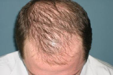 восстановить рост волос на голове