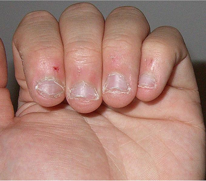Ребенок грызет ногти Комаровский 