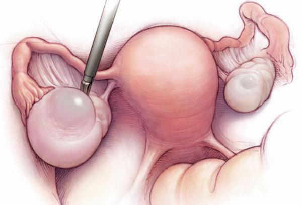 Удаление кисты яичника лапароскопия или полостная thumbnail