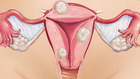 беременность при эндометриозе возможна