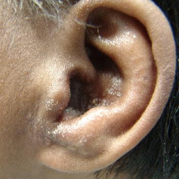 чем лечить отит уха