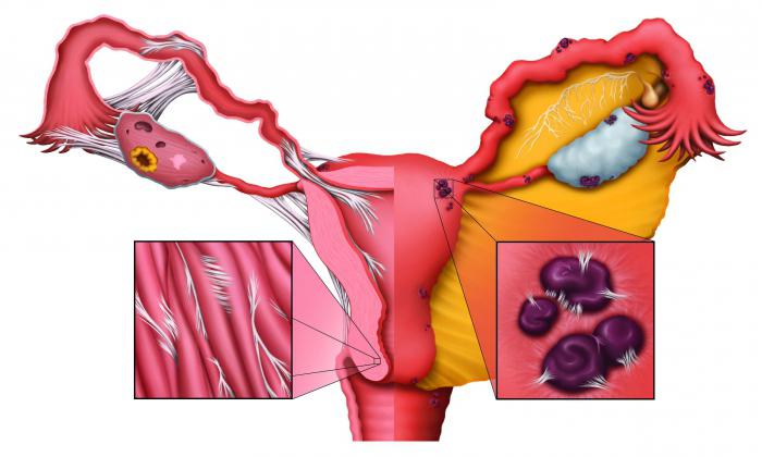 эндометриоз тела матки 