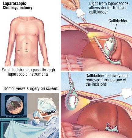 желчнокаменная болезнь операция