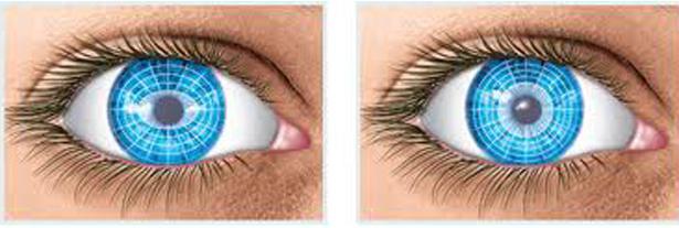 астигматизм глаз лечение