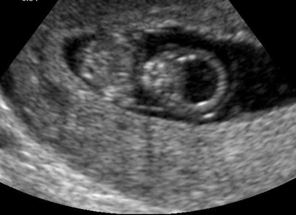 Шейка 6 недель. Эмбрион на 6 неделе беременности УЗИ. Снимок УЗИ на 6 неделе беременности. 6 Недель беременности фото плода на УЗИ. Фото эмбриона на 6 неделе беременности на УЗИ.
