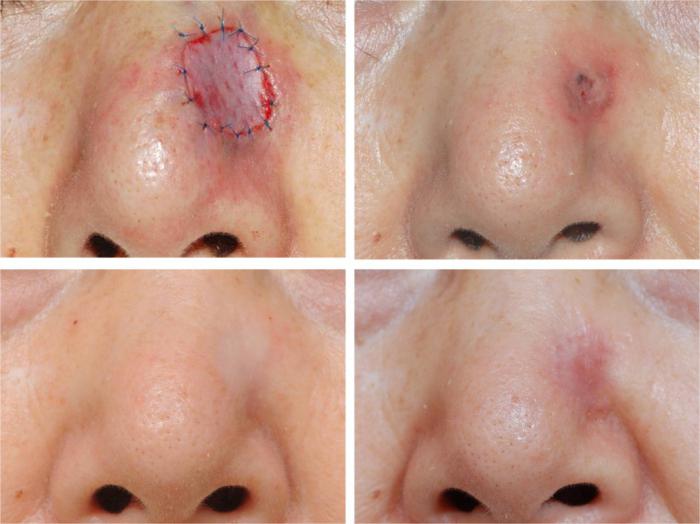 базалиома кожи носа лечение