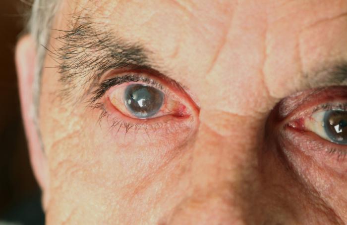 катаракта симптомы