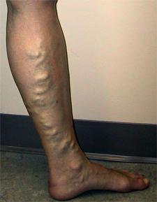 варикозное расширение вен на ногах