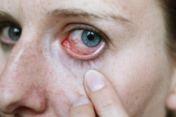 Кровоизлияние в глаз. Лечение