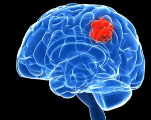 рак головного мозга симптомы признаки 